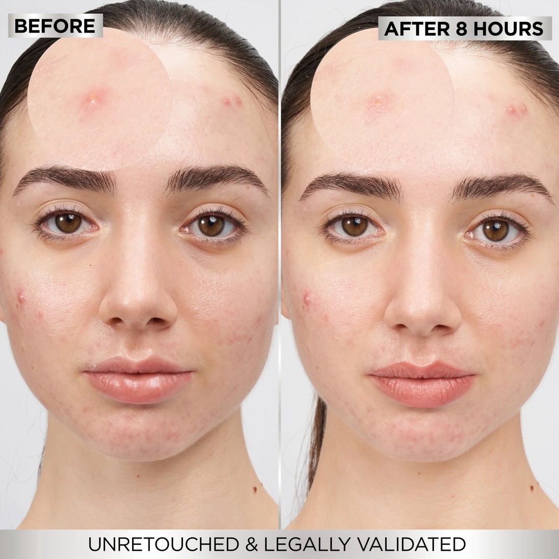 5 Garnier PureActive 22 Pack 8 Hour Invisible Pimple Patch - Hydrocolloid, 5 of 9