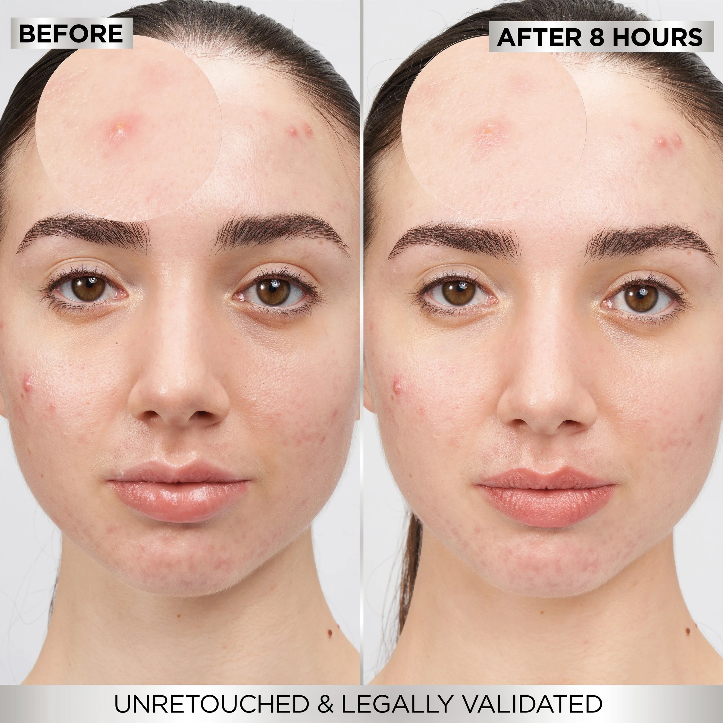 6 Garnier PureActive 22 Pack 8 Hour Invisible Pimple Patch - Hydrocolloid, 6 of 10